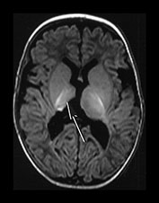 Thalamic Hemorrhage