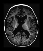 Thalamic Hemorrhage
