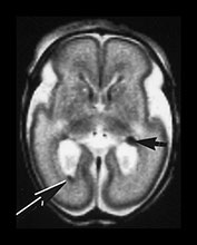 Fig. 9.24 (bii)