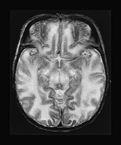 Fig. 17.4 (e)