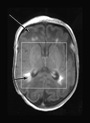 Fig. 17.11 (aii)